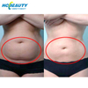 Factory Double Chin Slimming Cryo Machine Price