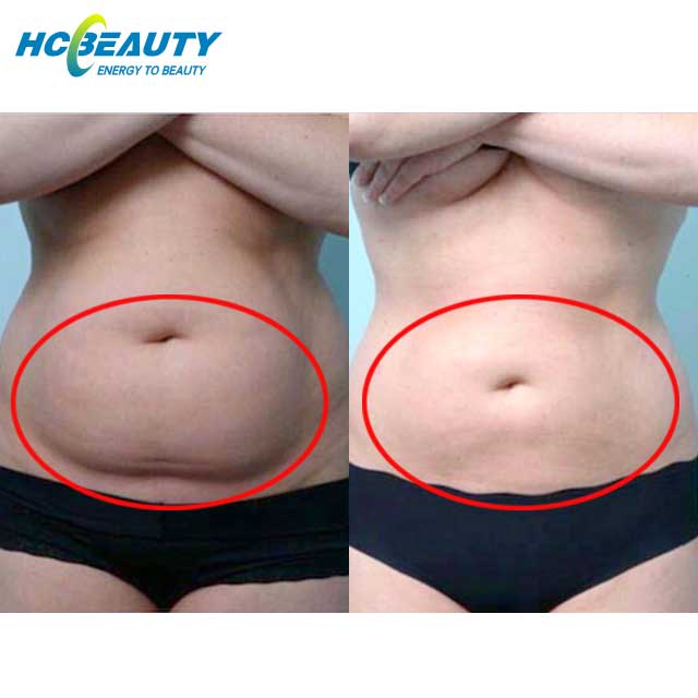 Factory Double Chin Slimming Cryo Machine Price