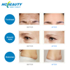 professional 11 lines 3d hifu wrinkle removal face