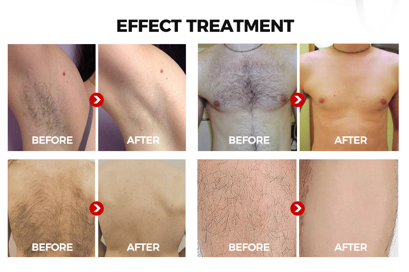 Diode Laser Hair Removal For Men: What You Need To Know