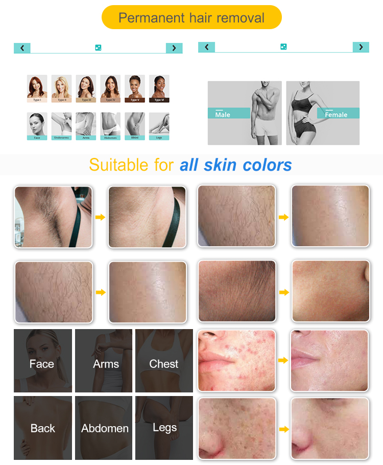 back hair removal cost